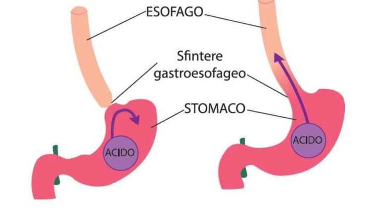 Reflusso gastroesofageo reflusso-gastroesofageo