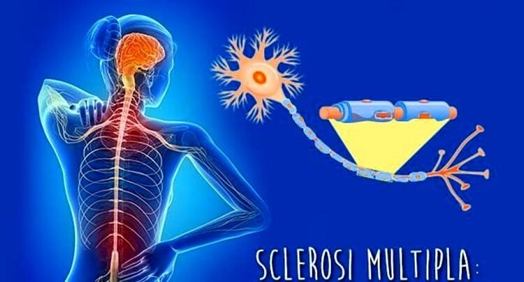 Osteopatia migliora i sintomi cronici nella Sclerosi Multipla: l’istituto IEMO promotore e garante dello studio pubblicato su JAOA studio su osteopatia e SM