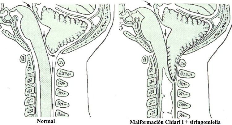 Sindrome di Chiari e osteopatia