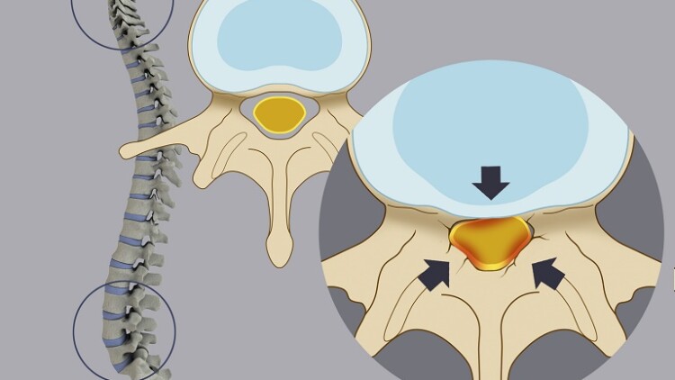 L’inaspettato ruolo dei legamenti gialli nella stenosi del canale vertebrale Stenosi del canale vertebrale: il ruolo del legamento giallo