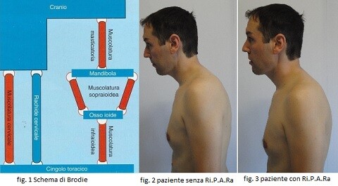 Anello Linguale Ri.P.A.Ra.: dispositivo per il trattamento osteopatico nei disordini cranio-cervico-mandibolari