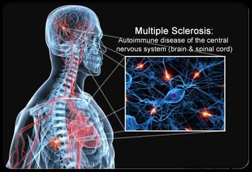 Osteopatia e sclerosi multipla: messo a punto un protocollo di trattamento osteopatico standard