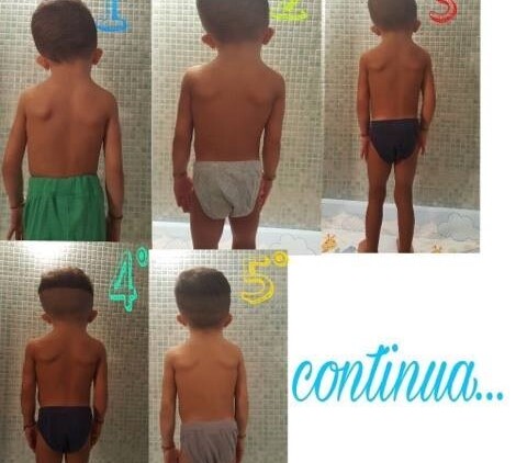 L’osteopatia riequilibra il torcicollo miogeno di un bambino: la testimonianza di due genitori